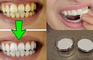 Voici comment blanchir vos dents jaunis en moins de 2 minutes