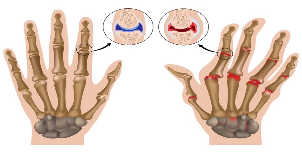 Causes, symptômes et traitement de la polyarthrite rhumatoïde | NewsMAG