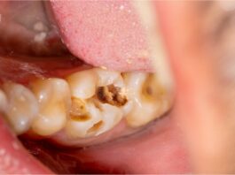 Comment se débarrasser définitivement de la carie dentaire sans douleur ?