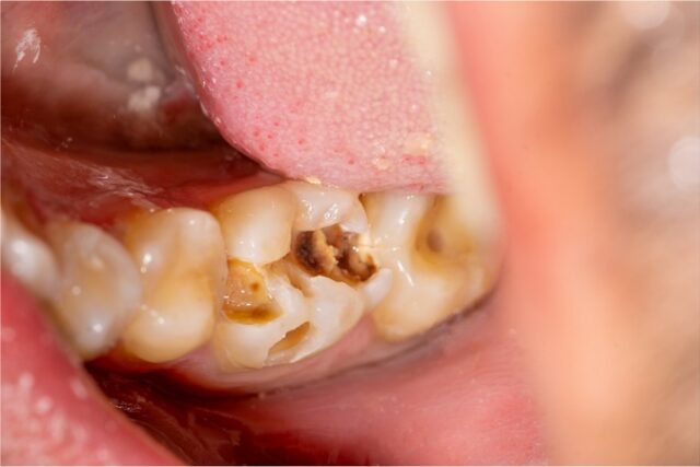 Comment se débarrasser définitivement de la carie dentaire sans douleur ?