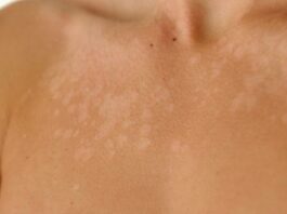 Taches blanches sur la peau : des remèdes naturelles pour faire les disparaître