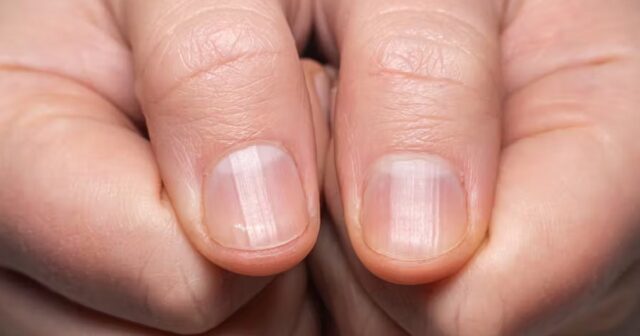 Est-il possible de remédier aux stries sur mes ongles ? Quelles en sont les causes ?